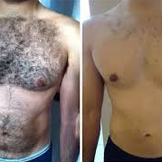 Picture of HAIR REMOVAL FULL BODY IN THE HOME FOR MEN TREATMENT