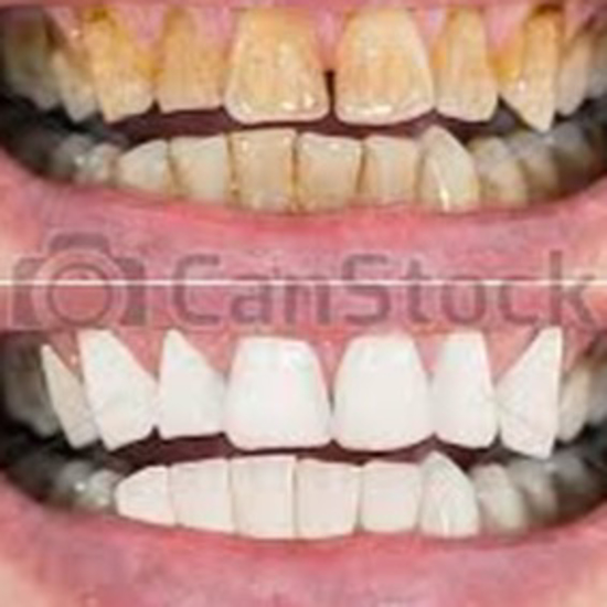 Picture of TEETH TREATMENT -MEN ONLY